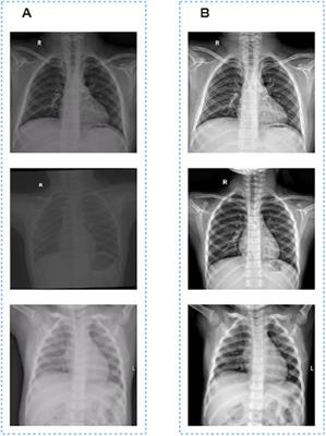 Development of lung segmentation method in x-ray images of children based on TransResUNet